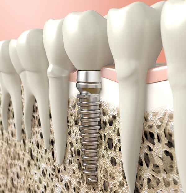 Dental-Implant-at-Elwood-Family-Dentist-Practice