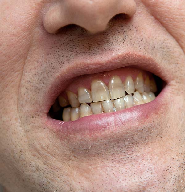 Stained-&-Discoloured-Teeth-Treatment-at-Elwood-Family-Dentist-Practice